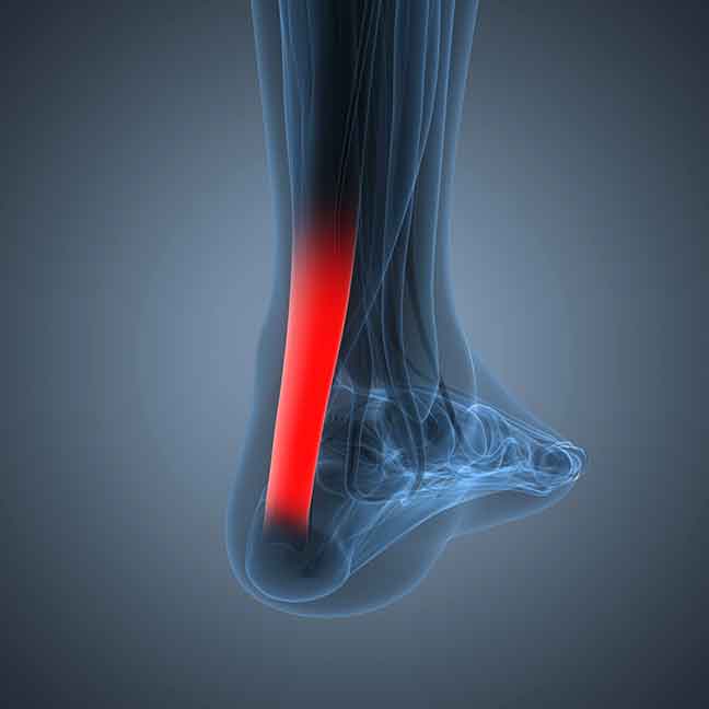 Ankle-tendonitis