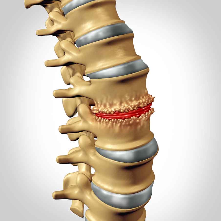 Bone-spurs