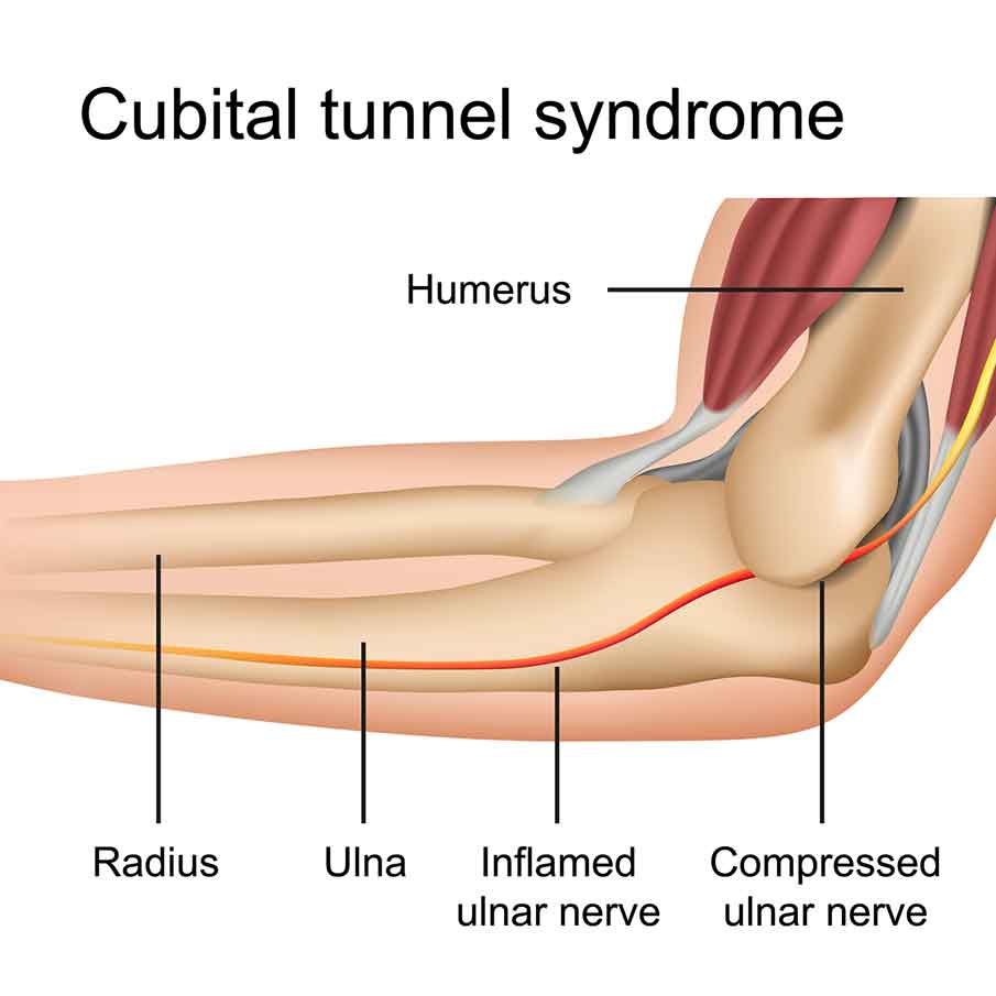 Cubital-tunnel-syndrome