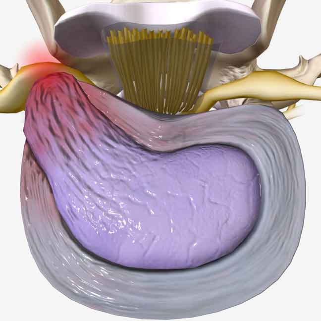 Herniated-bulging-or-ruptured-discs