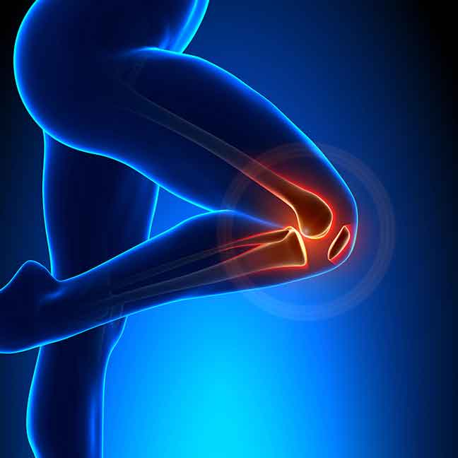 Patellar-tendonitis