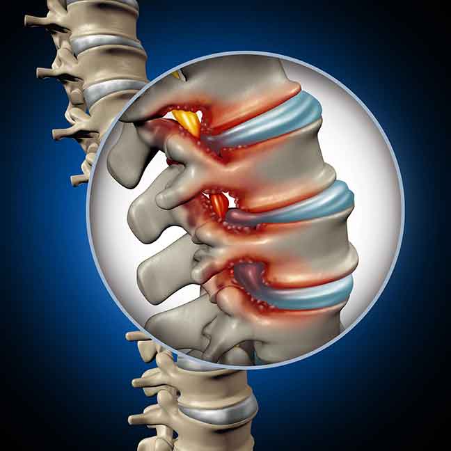 Spinal-stenosis
