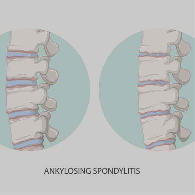 Spondylitis