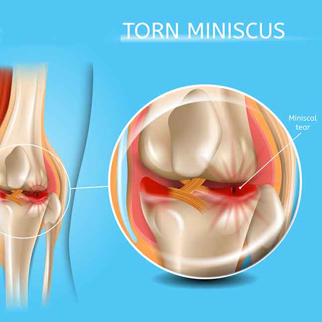 Torn-cartilage-also-referred-to-as-torn-meniscus