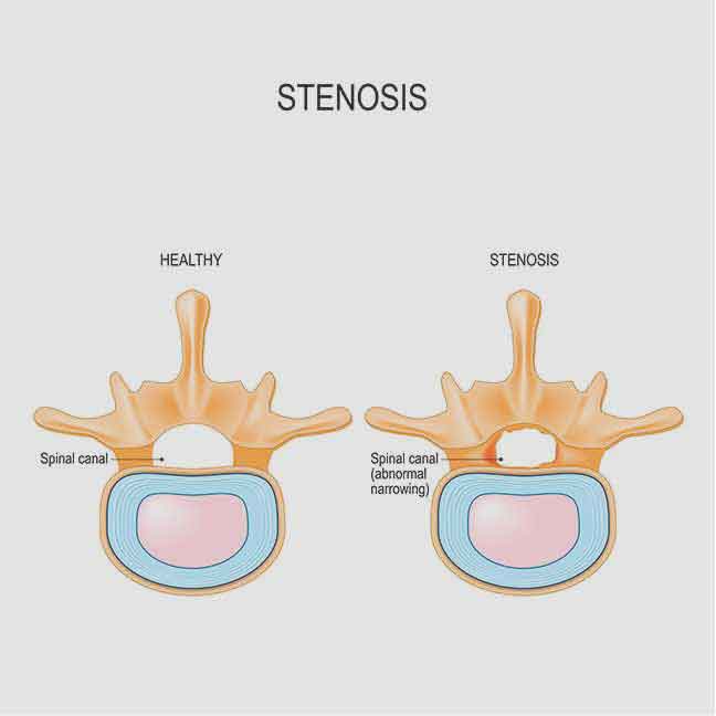 central-canal-stenosis