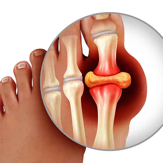 gout