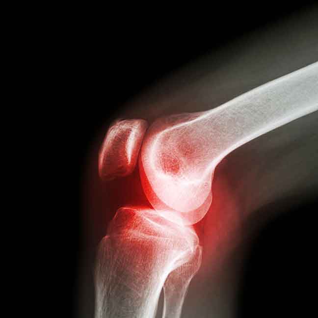 rheumatoid-arthritis