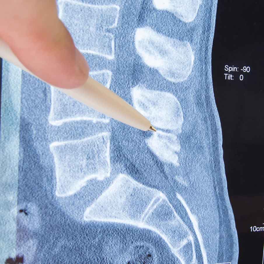 signs-of-a-pinched-nerve