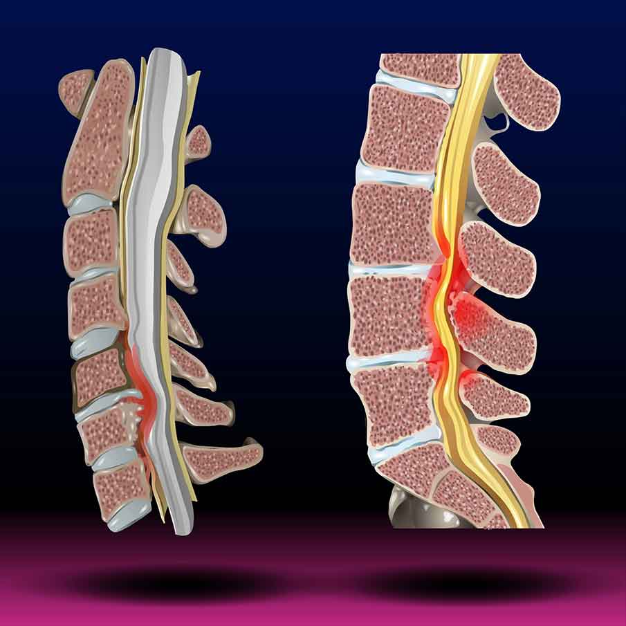 spinal-stenosis-or-herniated-disc