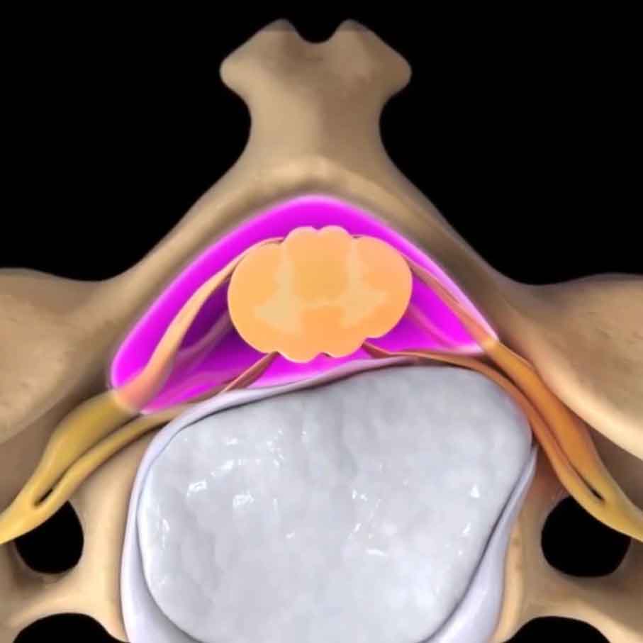 suffering-from-spinal-stenosis