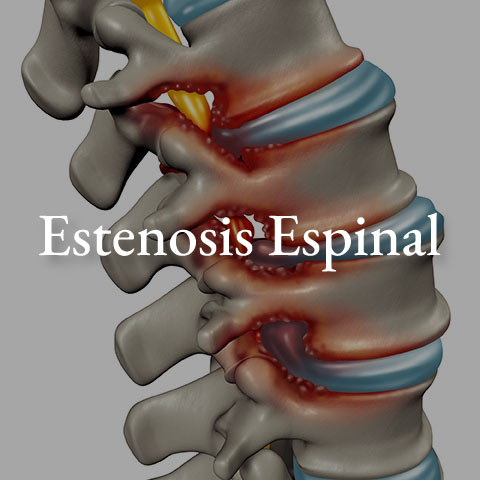 Estenosis-espinal