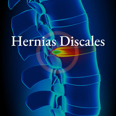 Hernias-discales