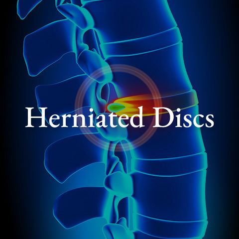 Herniated-discs