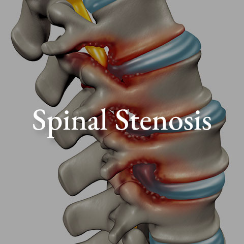Spinal-stenosis