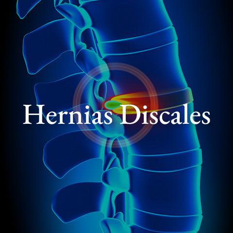 hernias-discales